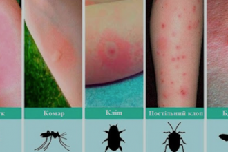 Як виглядають укуси комах: ознаки, симптоми та лікування